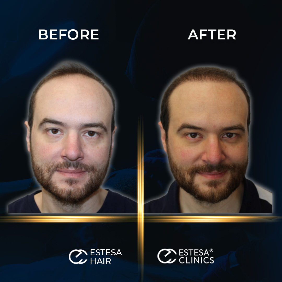 BEFORE AFTER4