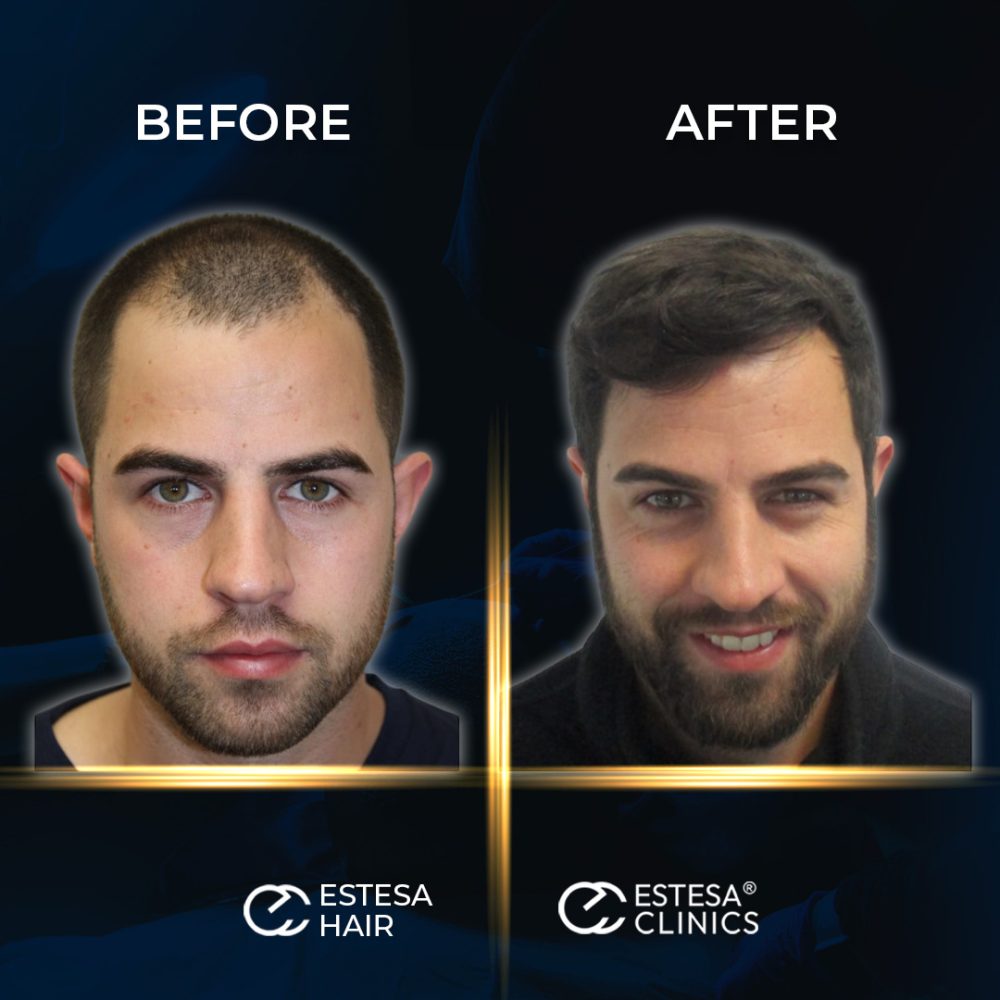 BEFORE-AFTER1-1