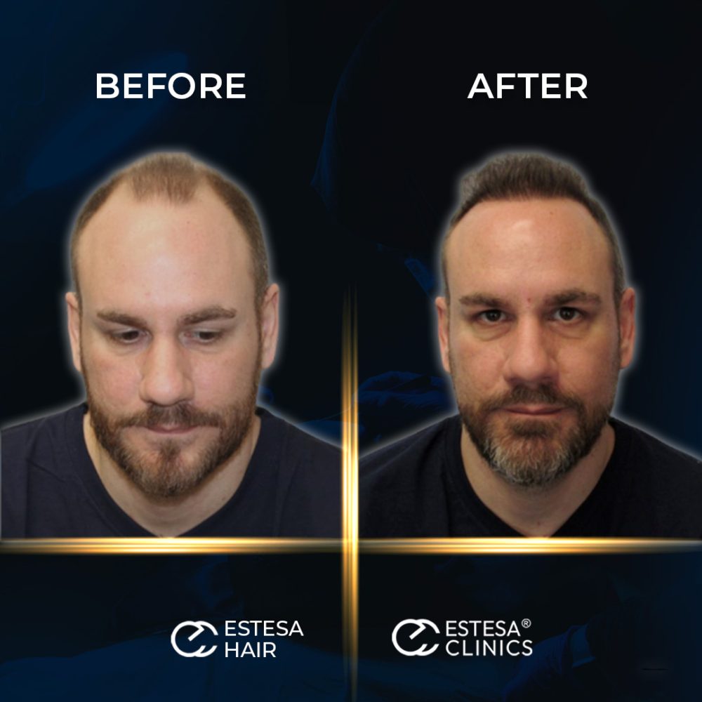 BEFORE-AFTER10