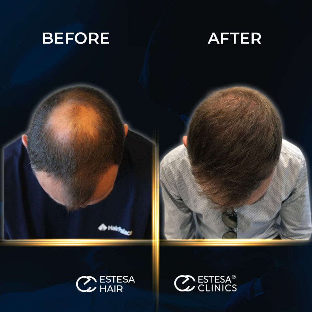 BEFORE-AFTER5