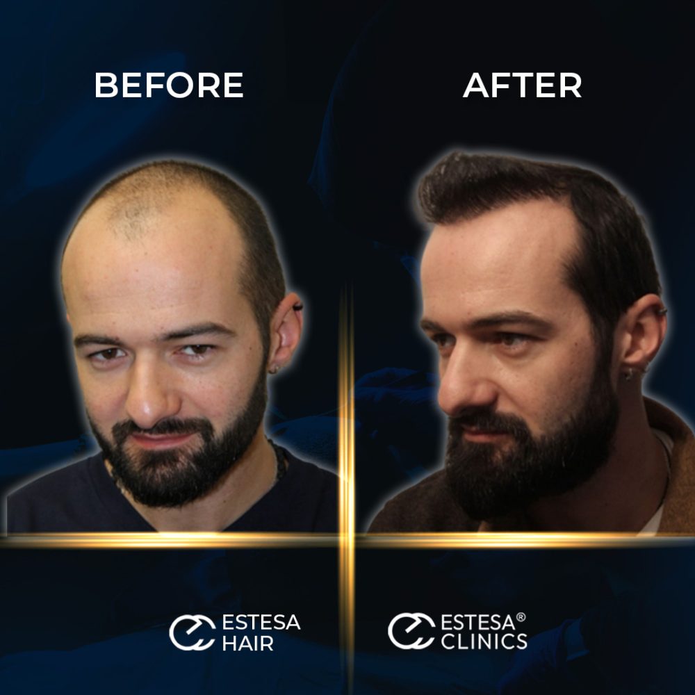 BEFORE-AFTER8