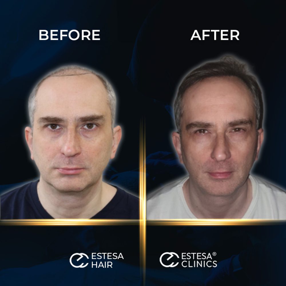 BEFORE-AFTER9